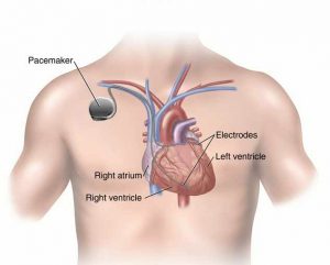 pacemaker